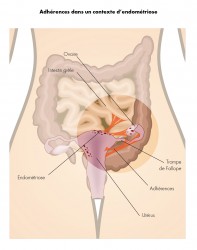 Adhérence dans un contexte d'endometriose