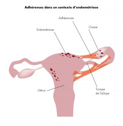 Détail d'adhérence dans un contexte d'endometriose