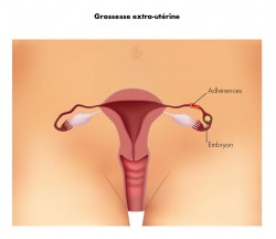 Adhérences grossesse extra uterine