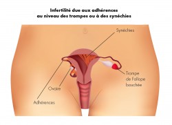 Infertilité due aux adhérences au niveau des trompes ou à des synéchies