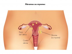 Adhérences fibromes-myomes