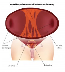 Adhérences à l'interieur de l'utérus